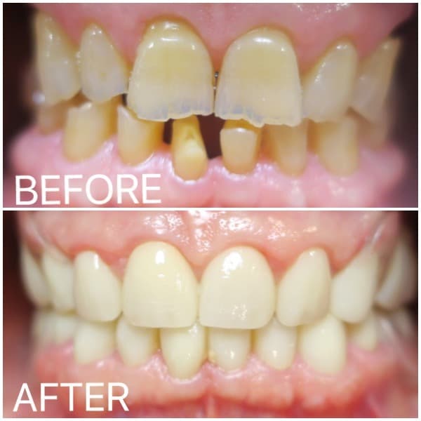 Smile transformation case at Wadhwa Dental Clinic