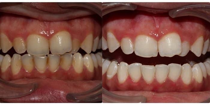 Dental before and after result at Wadhwa Dental Clinic