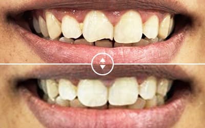 Tooth alignment and smile transformation result