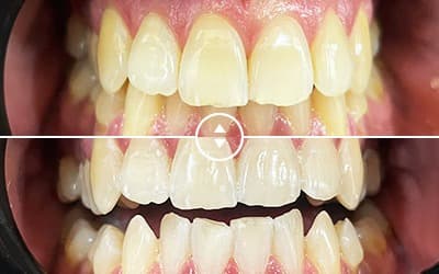 Smile improvement after dental treatment